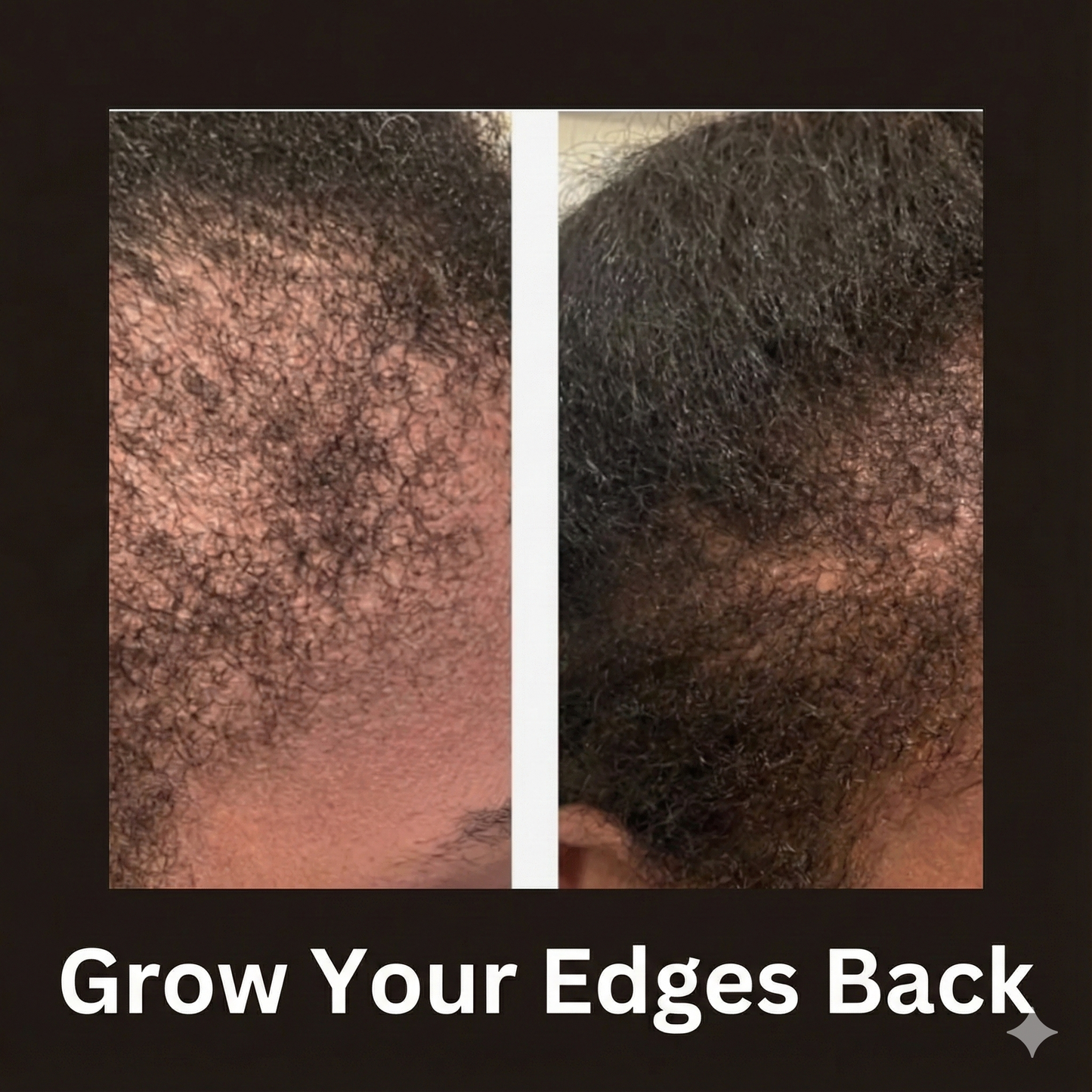 Grow Your Edges Back before and after results — edge growth and retention with Dynamic Duo system
