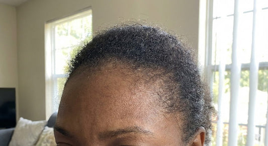 Can Traction Alopecia Be Reversed? The 3-Step Natural Protocol Dermatologists Miss