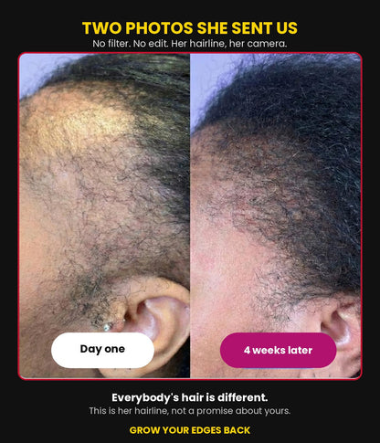 Customer photos of her hairline on day one and four weeks later